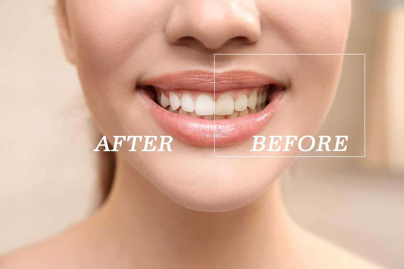 What Are the Most Effective Natural Teeth Whitening Methods You Can Try Dartford?