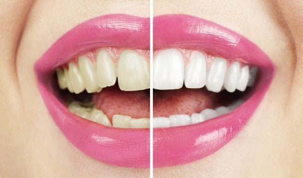 What Makes Ultima White Teeth Whitening Different Dartford