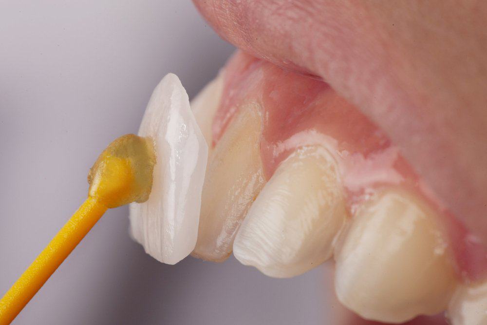Dental Veneers: Achieving a Flawless Look Dartford