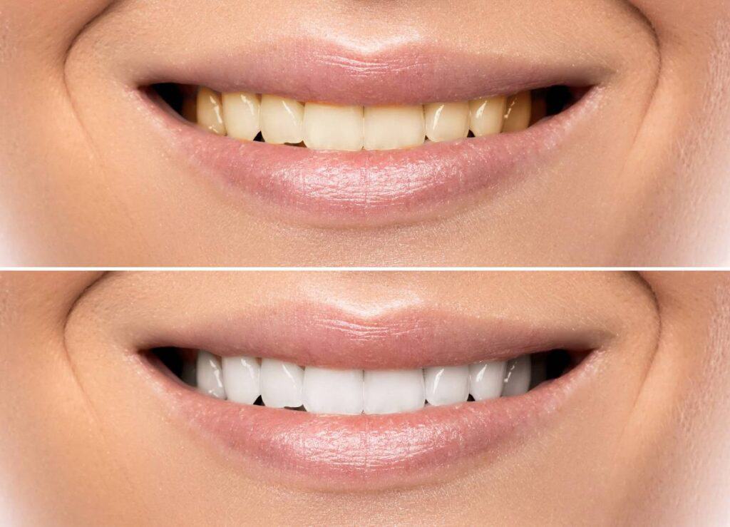 How Does Gum Disease Progress if Left Untreated Dartford?