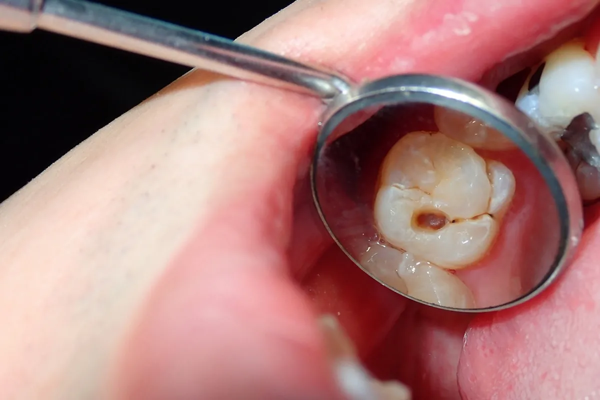 Why Do Teeth Crack? Common Causes to Know Dartford
