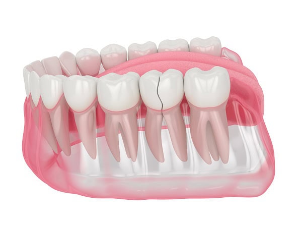 How Can You Manage Pain and Discomfort After a Root Canal Dartford?