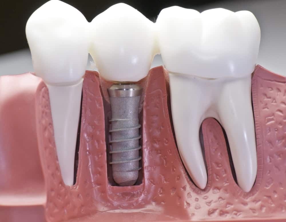 Common Misconceptions About Modern Dental Treatments Dartford