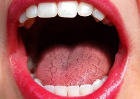 Dry Mouth and Its Role in Tooth Decay Dartford