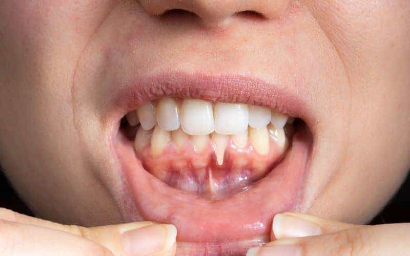 How Can Gum Disease Be Prevented Dartford?