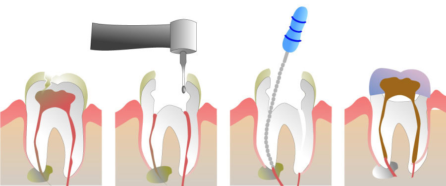 How Do You Properly Care for Your Teeth After a Root Canal Dartford