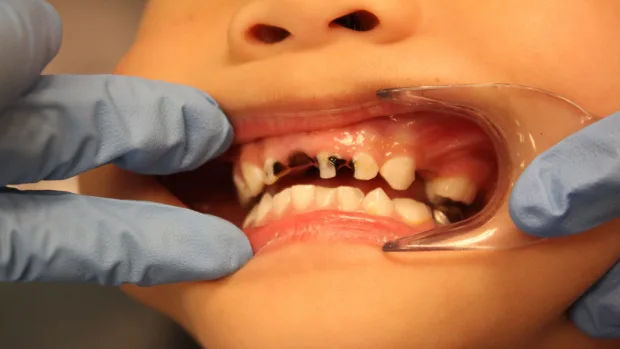 Which Foods and Drinks Cause the Most Damage to Young Smiles Dartford?