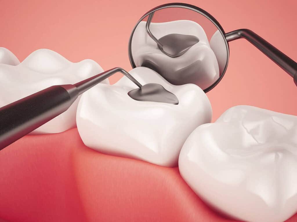 Fighting Cavities and Plaque Buildup Dartford