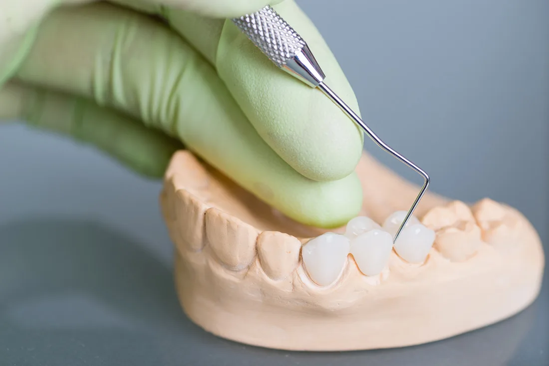 Do Braces Take Years to Show Results Dartford