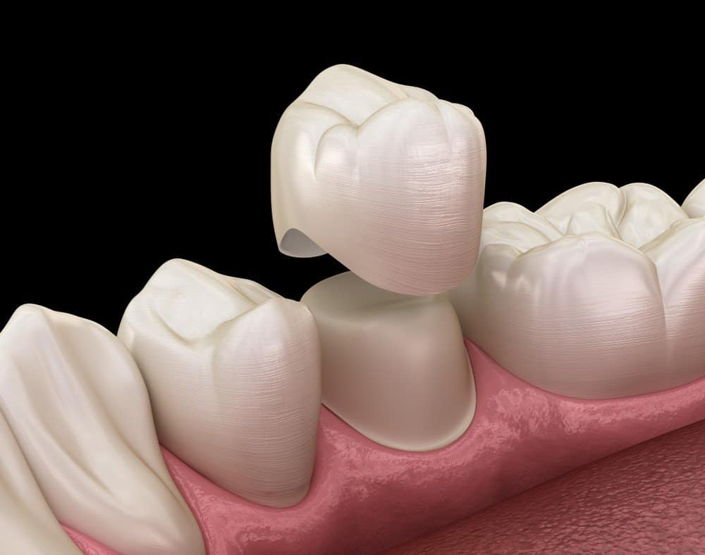 How Can You Prevent Common Dental Crown Problems Dartford?