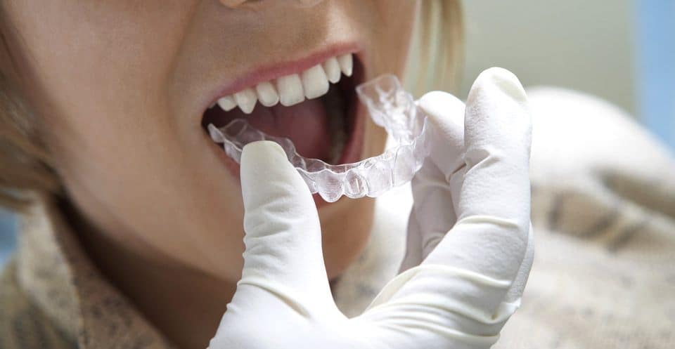 How Much Does Laser Teeth Whitening Cost Compared to Overnight Trays Dartford?