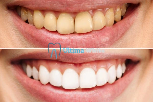 Oral Care Tips for Current and Former Smokers Dartford