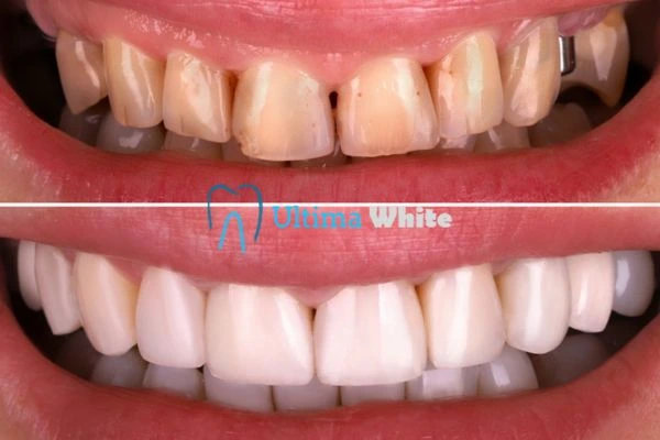 What Makes Instant Teeth Whitening Treatments So Popular Dartford?