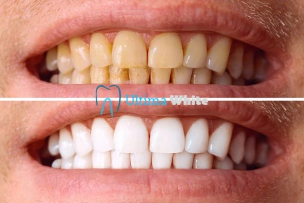 Stained Teeth and Persistent Bad Breath Dartford