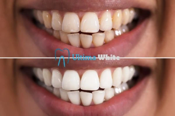 Aftercare Tips to Maintain Your New Smile Dartford